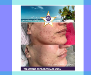 SkinBase Microdermabrasion skin treatments at the Letchworth Clinic