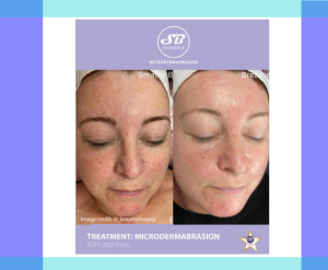 SkinBase Microdermabrasion skin treatments at the Letchworth Clinic
